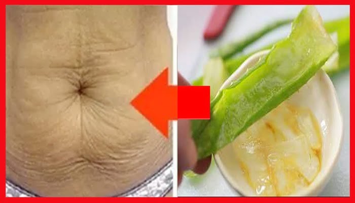 Tratamientos caseros para las estrías